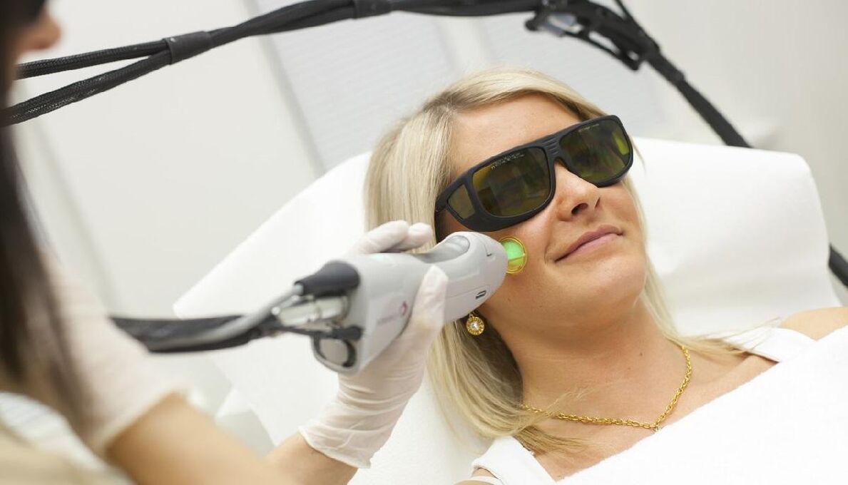 Laser renewal