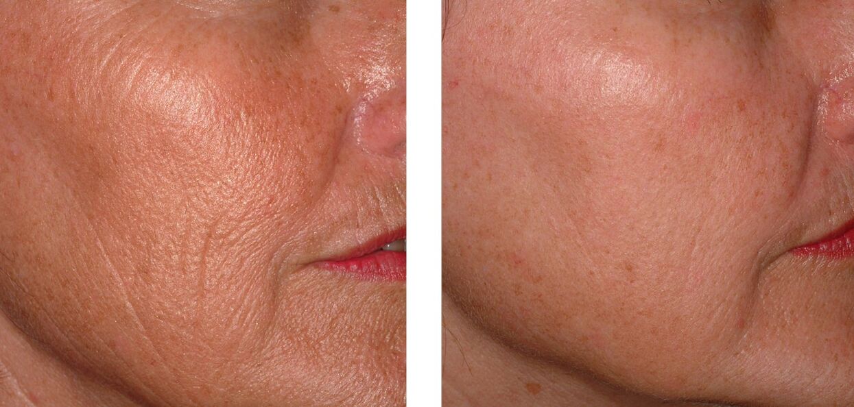 Renew the skin
