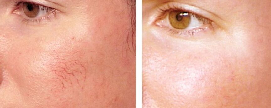 Eliminate Rosacea