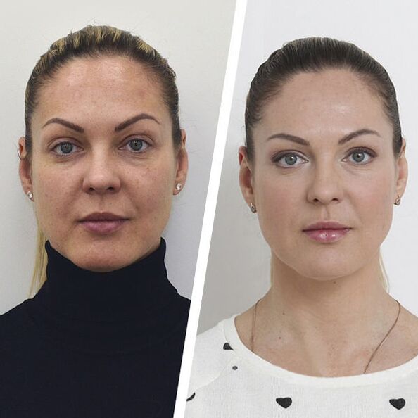Before and after facial skin rejuvenation without surgery