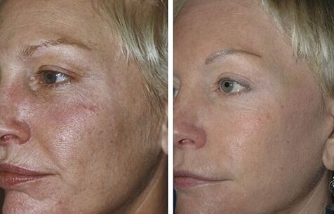 fractional laser rejuvenation before and after photos