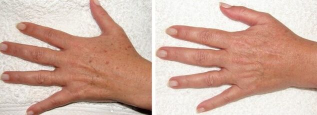 Resulting in the removal of pigment spots on the hands