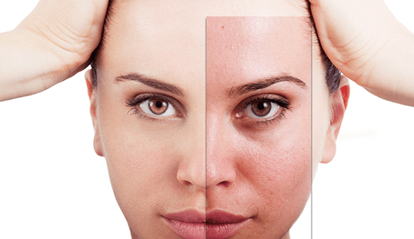 fractional regeneration removes the main aesthetic defects of the person