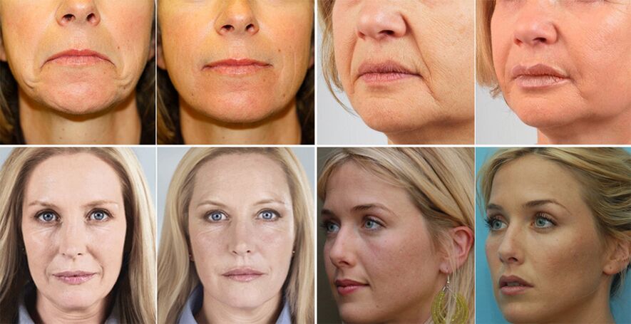 photos of women before and after facial skin rejuvenation