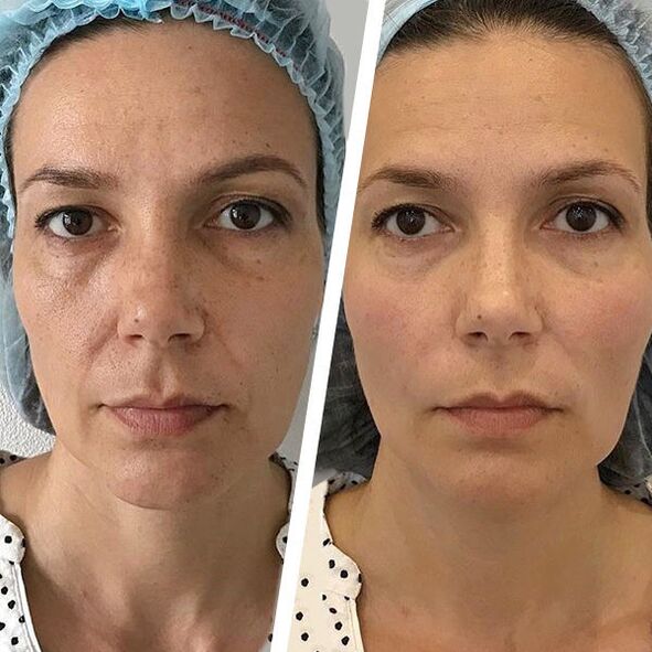 face photo before and after laser rejuvenation